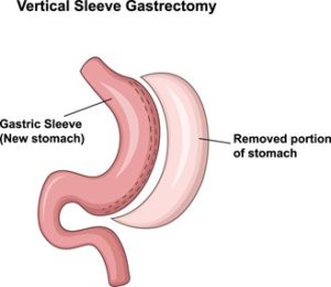 Gastric Sleeve illustration